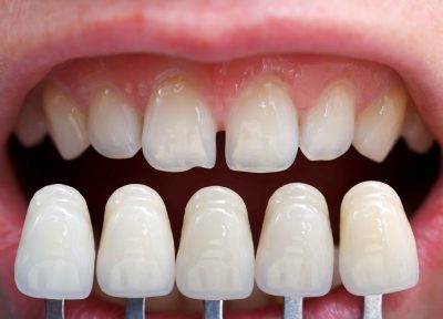 featured image for porcelain veneer