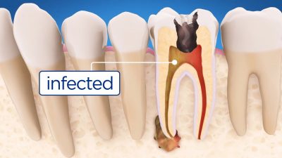 featured image for root canal service