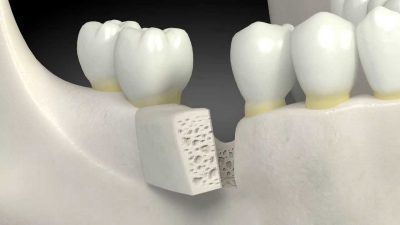 featured image for the best best bone grafting procedure