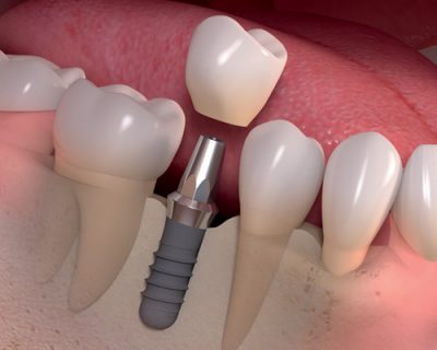 featured image for the best dental implants in the Philippines