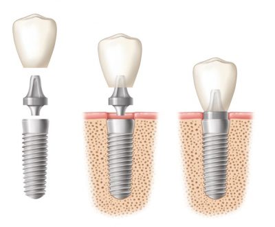 featured image for dental implants