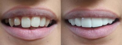 featured image for porcelain veneers