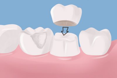 featured image for dental crown