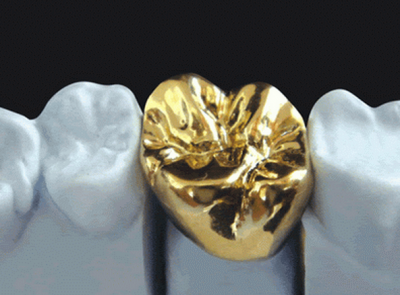 featured image for dental crown