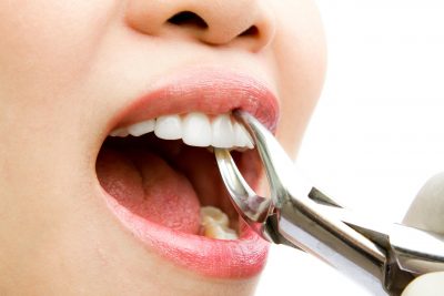 featured image for tooth extraction