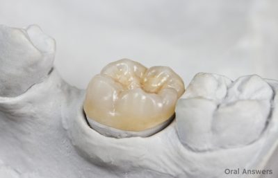 featured image for affordable dental crown