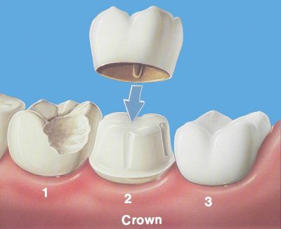 featured image for dental crown in Manila