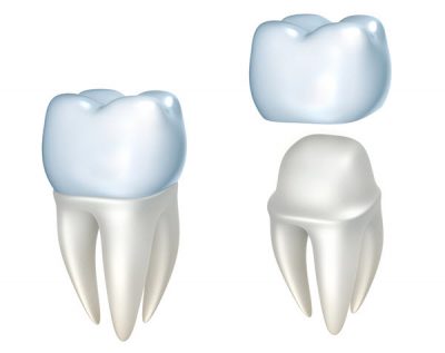 featured image for best dental crowns