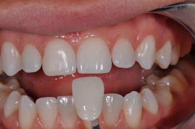 featured image for porcelain veneers in the Philippines