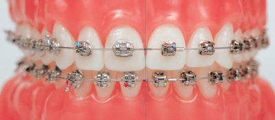 orthodontic braces in Manila