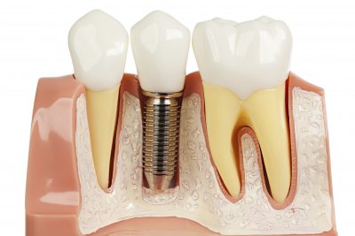 image for dental implants in Manila