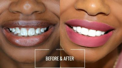 affordable porcelain veneers in Manila