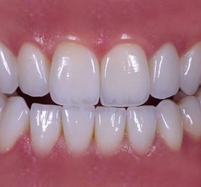 featured image for zirconia crown in the Philippines