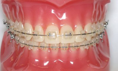 featured image for dental braces in Quezon City