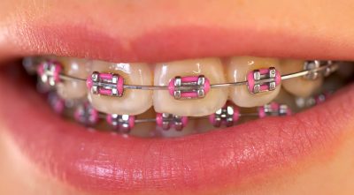 featured image for affordable braces in Quezon City