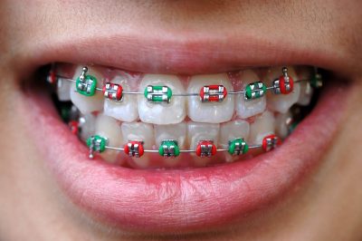 featured image for price of braces in the philippines