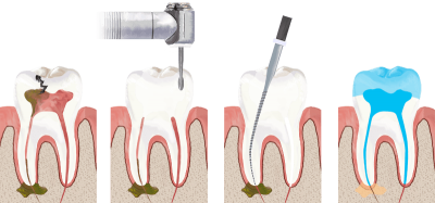 featured image for cost of root canal in the philippines