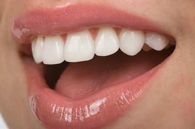 featured image for price of veneers in the Philippines