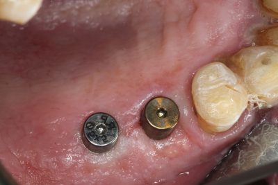 featured image for tooth implant in the philippines