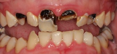 featured image for causes of tooth decay