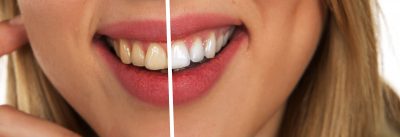 featured image for foods that whiten teeth