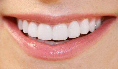 featured image for benefits of porcelain veneers