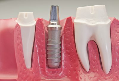 featured image for implant dentist in manila