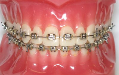 featured image for orthodontic braces in the Philippines