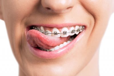 featured image for orthodontist in manila