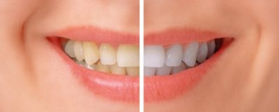 featured image for teeth whitening in the Philippines