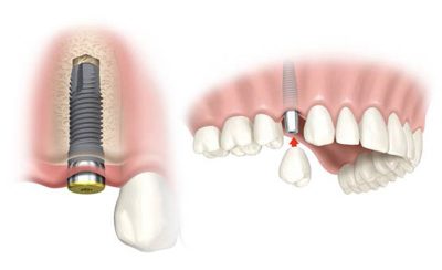 featured image for cost of a tooth implant in the philippines