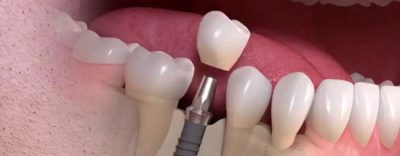 featured image for what are dental implants