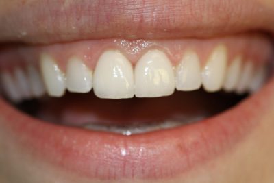 featured image for what is a dental crown