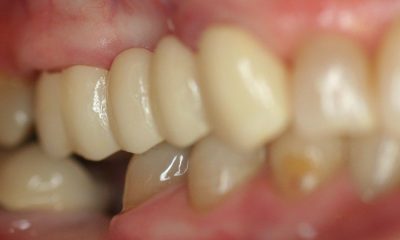 featured image for what is a dental bridge