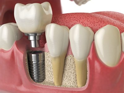 featured image for dental implants in the Philippines