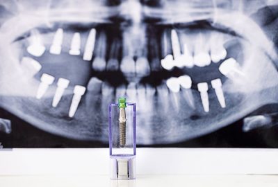 image for dental implants in the Philippines