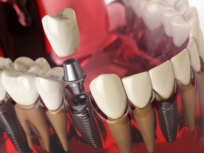 Is a dental implant worth it