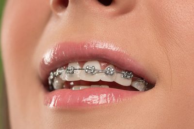 featured image for price of braces in the Philippines in 2018