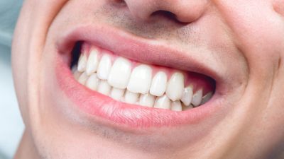 image for How do you whiten your teeth