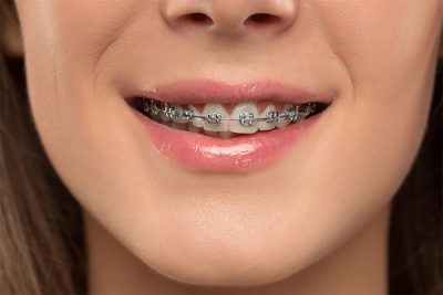 featured image for cost of metal braces